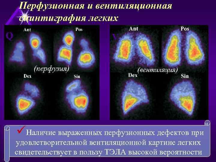 Перфузионная и вентиляционная сцинтиграфия легких Q V (перфузия) (вентиляция) üНаличие выраженных перфузионных дефектов при