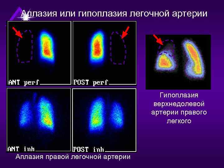 Аплазия или гипоплазия легочной артерии Гипоплазия верхнедолевой артерии правого легкого Аплазия правой легочной артерии