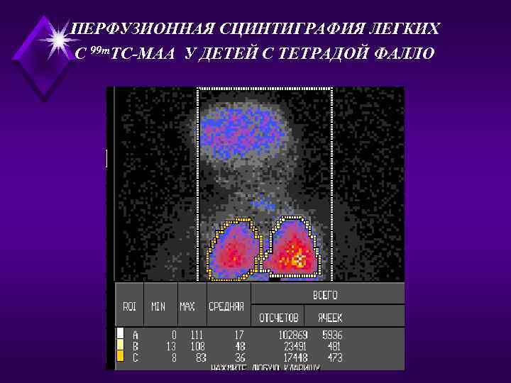 ПЕРФУЗИОННАЯ СЦИНТИГРАФИЯ ЛЕГКИХ С 99 m. ТС-МАА У ДЕТЕЙ С ТЕТРАДОЙ ФАЛЛО 