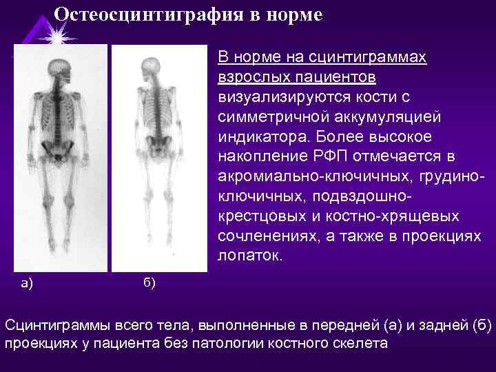 Остеосцинтиграфия в норме В норме на сцинтиграммах взрослых пациентов визуализируются кости с симметричной аккумуляцией