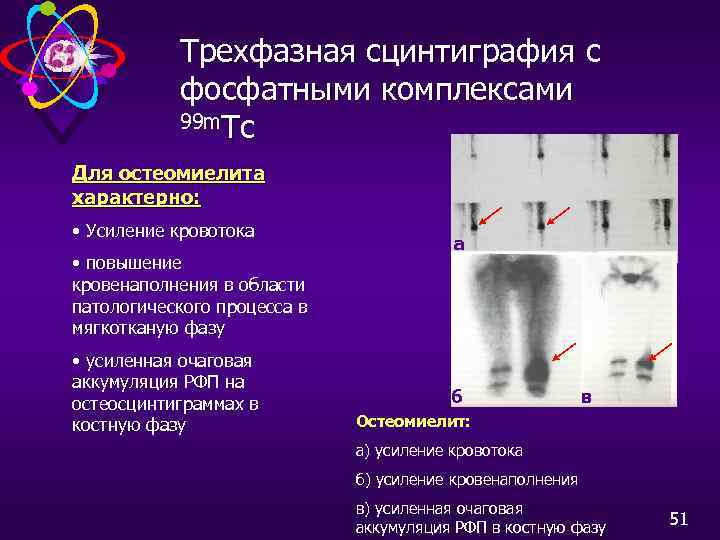 Трехфазная сцинтиграфия с фосфатными комплексами 99 m. Тс Для остеомиелита характерно: • Усиление кровотока