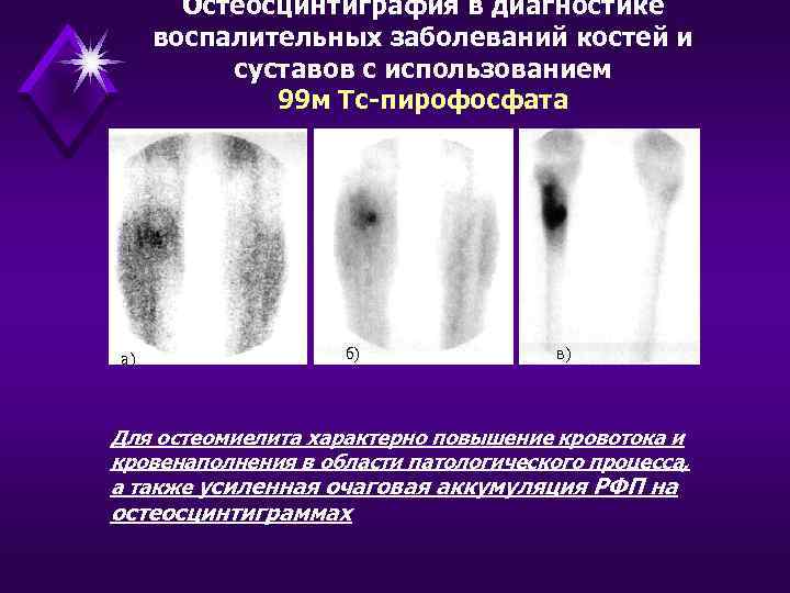 Остеосцинтиграфия в диагностике воспалительных заболеваний костей и суставов с использованием 99 м Тс-пирофосфата а)