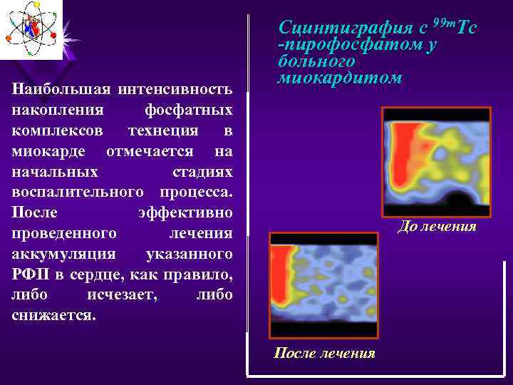 Наибольшая интенсивность накопления фосфатных комплексов технеция в миокарде отмечается на начальных стадиях воспалительного процесса.