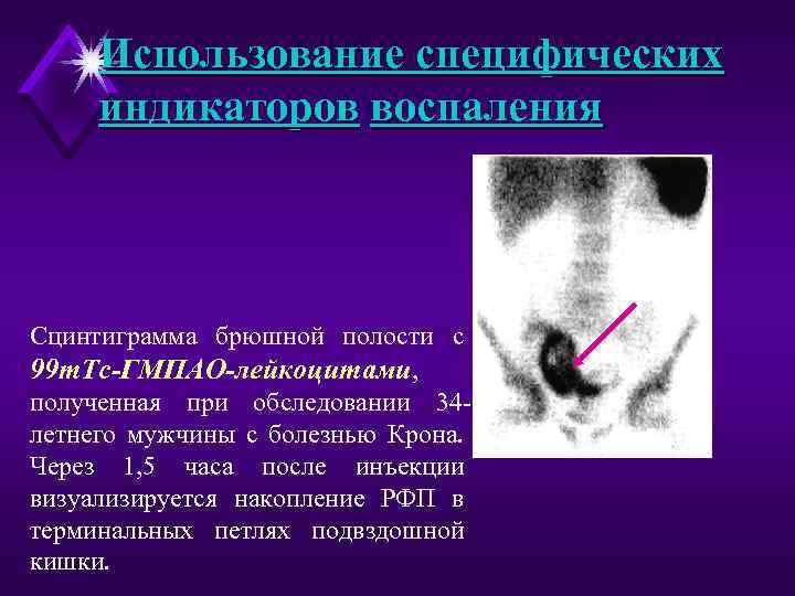 Использование специфических индикаторов воспаления Сцинтиграмма брюшной полости с 99 m. Tc-ГМПАО-лейкоцитами, полученная при обследовании