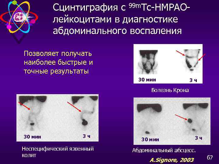 Сцинтиграфия с 99 m. Tc-HMPAOлейкоцитами в диагностике абдоминального воспаления Позволяет получать наиболее быстрые и