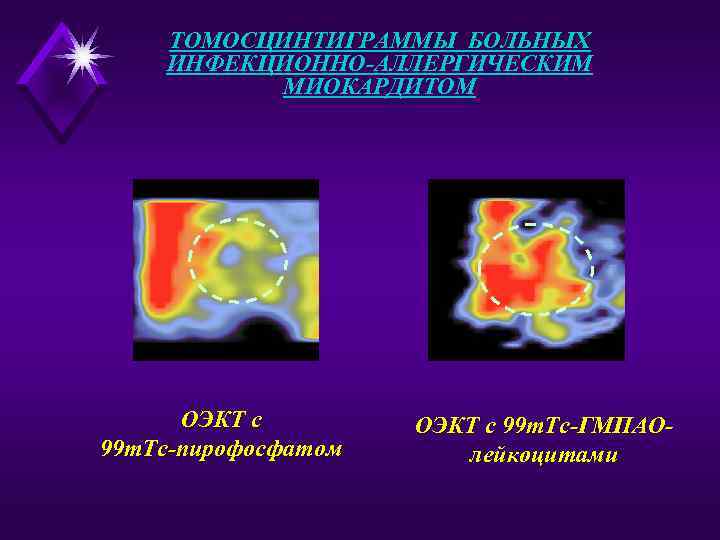 ТОМОСЦИНТИГРАММЫ БОЛЬНЫХ ИНФЕКЦИОННО-АЛЛЕРГИЧЕСКИМ МИОКАРДИТОМ ОЭКТ с 99 m. Тс-пирофосфатом ОЭКТ с 99 m. Тс-ГМПАОлейкоцитами