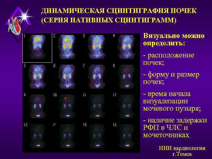 ДИНАМИЧЕСКАЯ СЦИНТИГРАФИЯ ПОЧЕК (СЕРИЯ НАТИВНЫХ СЦИНТИГРАММ) Визуально можно определить: - расположение почек; - форму