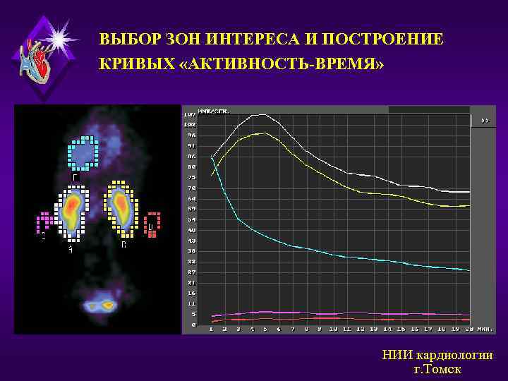 ВЫБОР ЗОН ИНТЕРЕСА И ПОСТРОЕНИЕ КРИВЫХ «АКТИВНОСТЬ-ВРЕМЯ» НИИ кардиологии г. Томск 