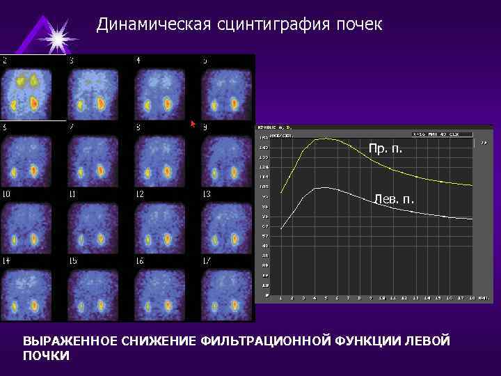 Динамическая сцинтиграфия почек Пр. п. Лев. п. ВЫРАЖЕННОЕ СНИЖЕНИЕ ФИЛЬТРАЦИОННОЙ ФУНКЦИИ ЛЕВОЙ ПОЧКИ 