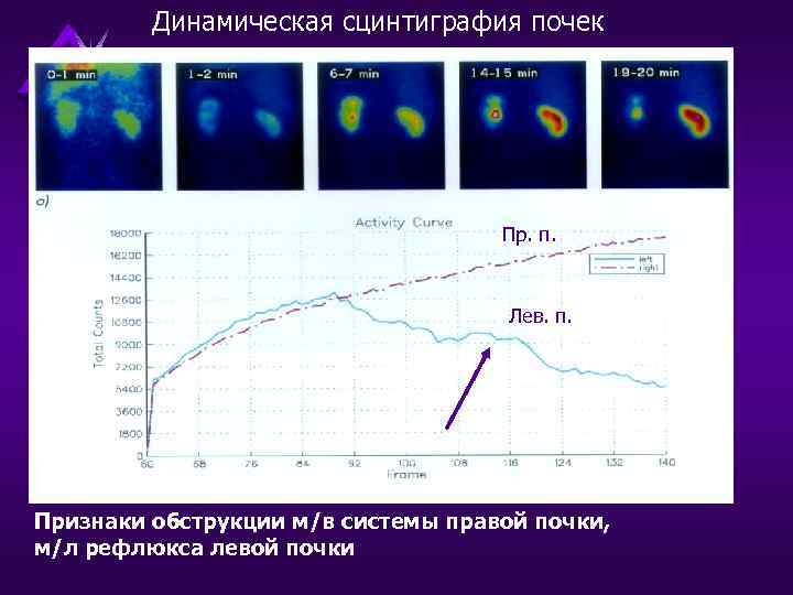 Может ли сцинтиграфия не увидеть мтс