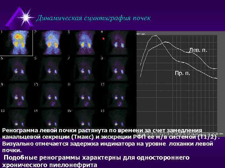 Динамическая сцинтиграфия почек Лев. п. Пр. п. Ренограмма левой почки растянута по времени за