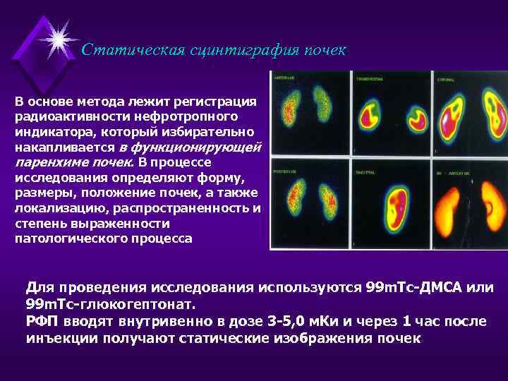 Статическая сцинтиграфия почек В основе метода лежит регистрация радиоактивности нефротропного индикатора, который избирательно накапливается