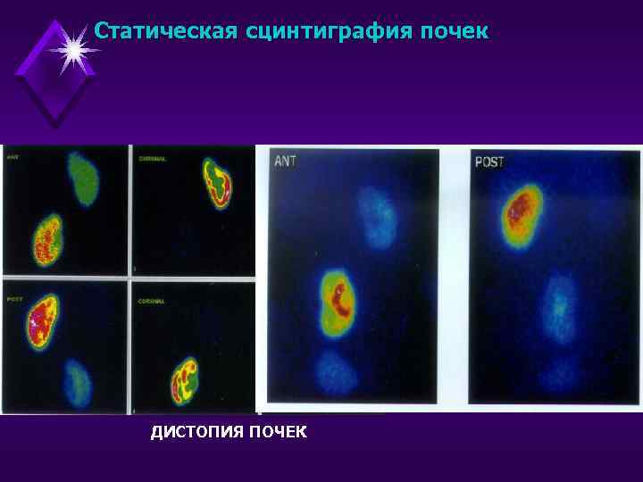 Статическая сцинтиграфия почек ДИСТОПИЯ ПОЧЕК 