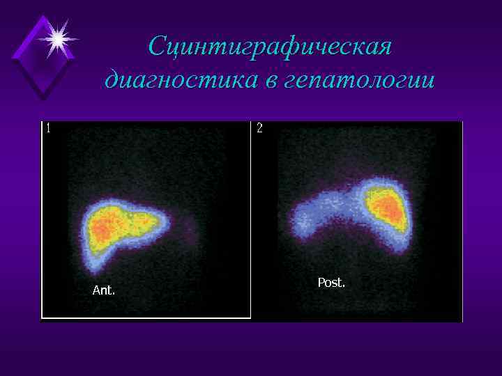 Сцинтиграфическая диагностика в гепатологии Ant. Post. 