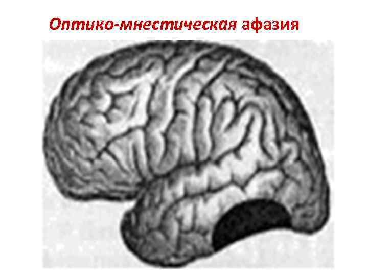 Сенсорная афазия картинки