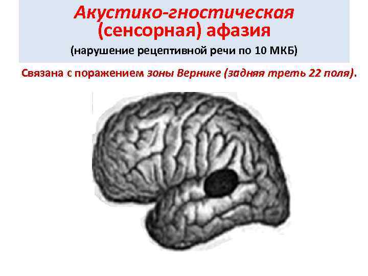 Акустико-гностическая (сенсорная) афазия (нарушение рецептивной речи по 10 МКБ) Связана с поражением зоны Вернике