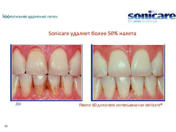Эффективное удаление пятен Sonicare удаляет более 50% налета До 22 После 10 дневного использования