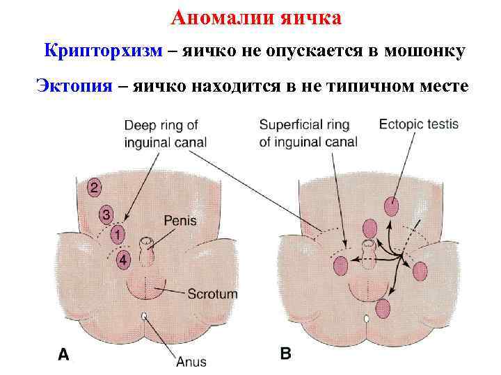 Аномалии яичка Крипторхизм – яичко не опускается в мошонку Эктопия – яичко находится в