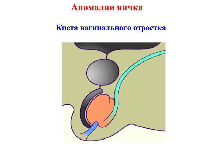 Аномалии яичка Киста вагинального отростка 