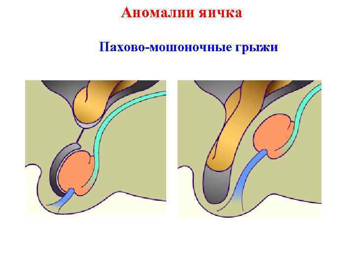 Аномалии яичка Пахово-мошоночные грыжи 