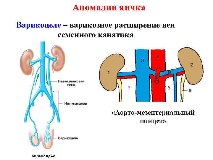 Аномалии яичка Варикоцеле – варикозное расширение вен семенного канатика «Аорто-мезентериальный пинцет» 