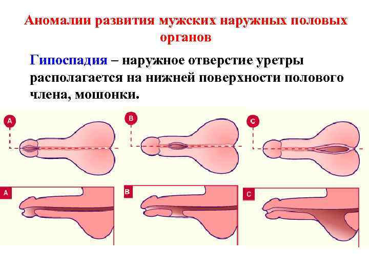 Аномалии развития мужских наружных половых органов Гипоспадия – наружное отверстие уретры располагается на нижней