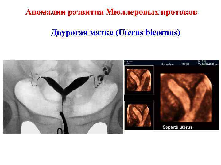 Аномалии развития Мюллеровых протоков Двурогая матка (Uterus bicornus) 