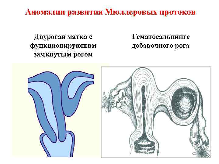 Аномалии развития Мюллеровых протоков Двурогая матка с функционирующим замкнутым рогом Гематосальпингс добавочного рога 