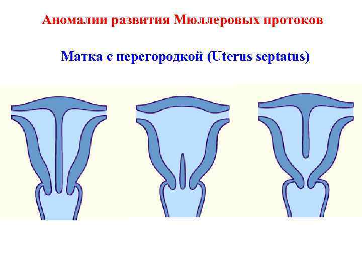 Аномалии развития Мюллеровых протоков Матка с перегородкой (Uterus septatus) 