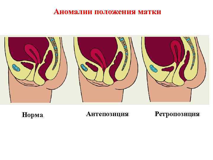 Аномалии положения матки Норма Антепозиция Ретропозиция 