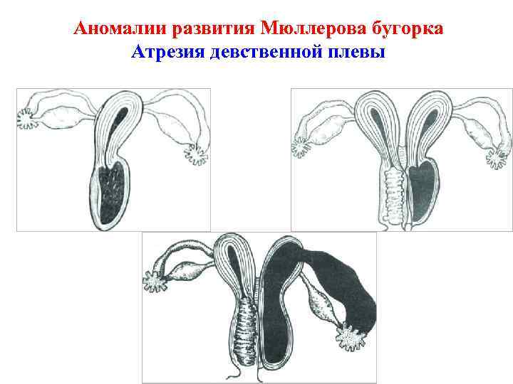 Аномалии развития Мюллерова бугорка Атрезия девственной плевы 