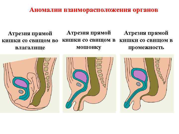 Аномалии взаиморасположения органов Атрезия прямой кишки со свищом во кишки со свищом в мошонку