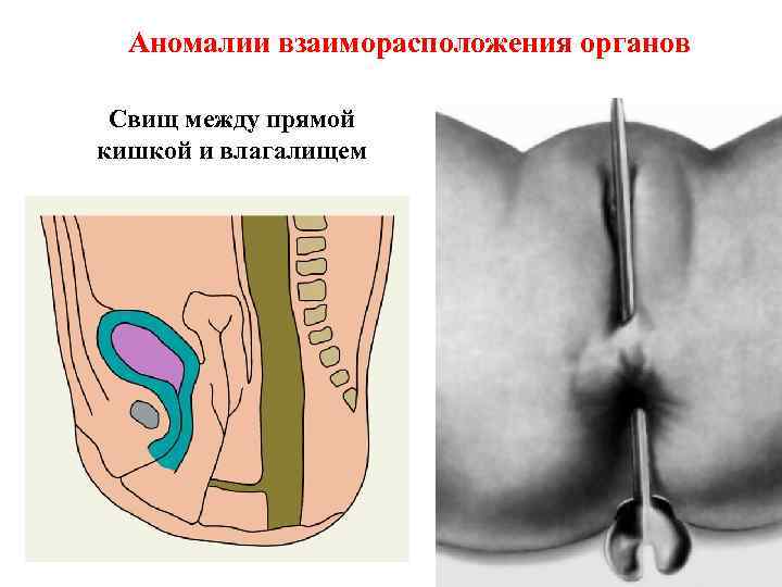 Аномалии взаиморасположения органов Свищ между прямой кишкой и влагалищем 