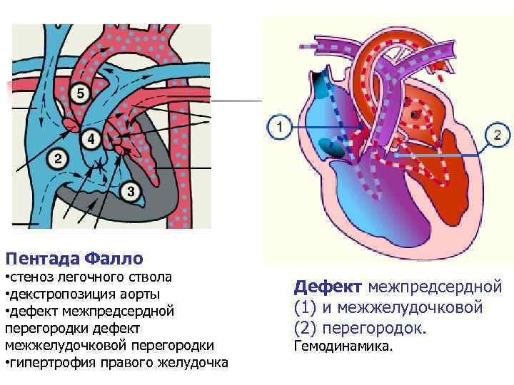 Триада фалло презентация