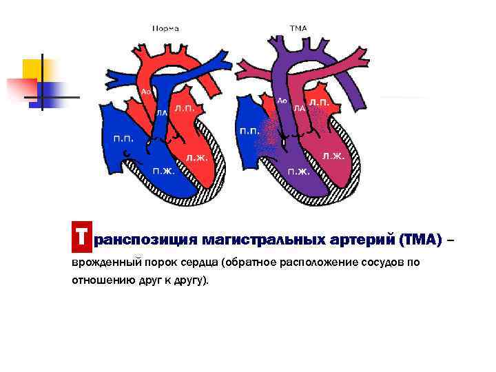 Магистральные сосуды это. ТМС порок сердца гемодинамика. ВПС транспозиция магистральных сосудов. Врожденные пороки сердца и магистральных сосудов. Схема магистральных сосудов.