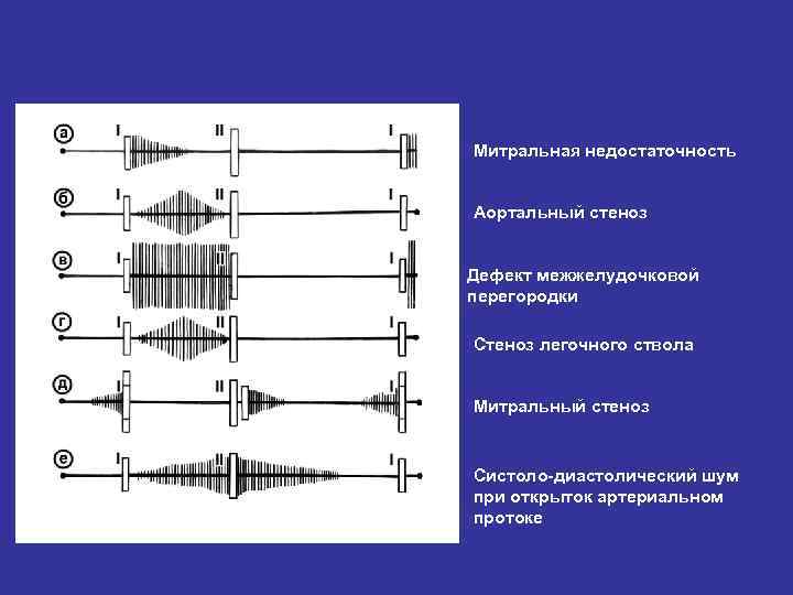 Аускультативная картина при открытом артериальном протоке характеризуется наличием