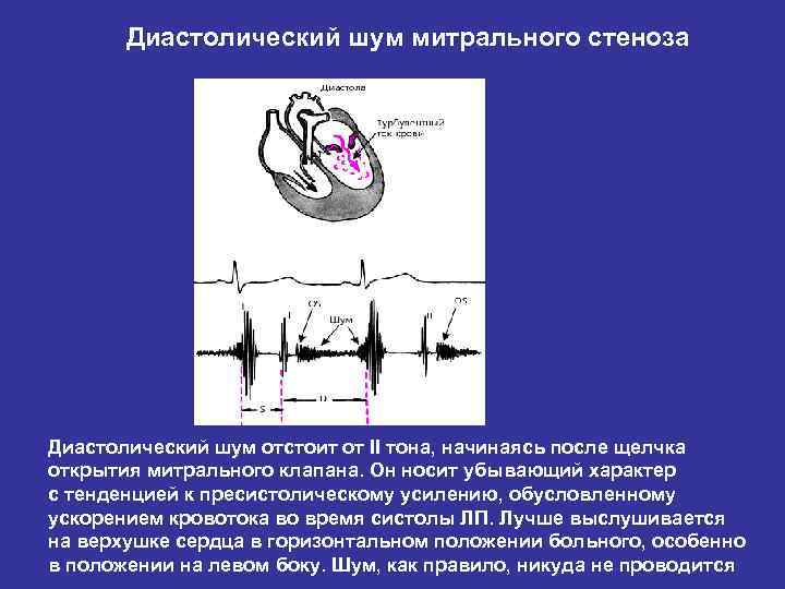 Градиент на митральном клапане