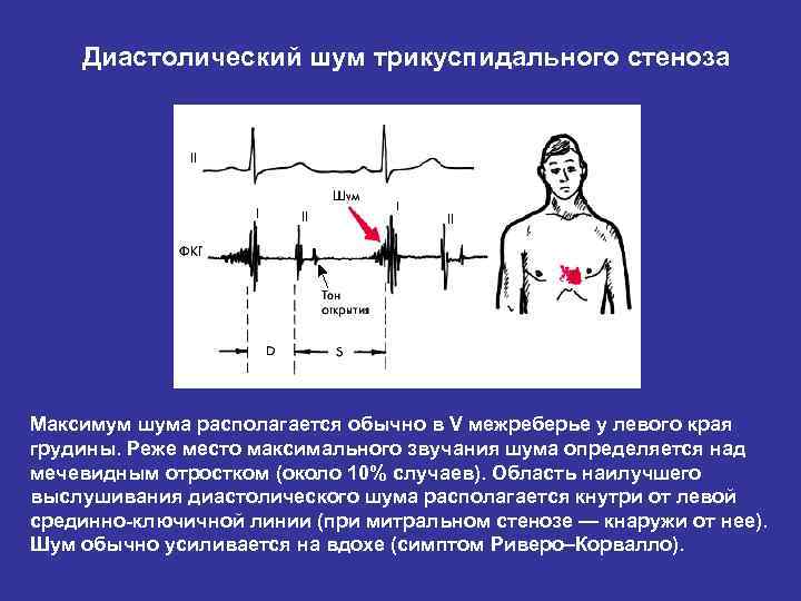 Аускультативная картина трикуспидальной недостаточности