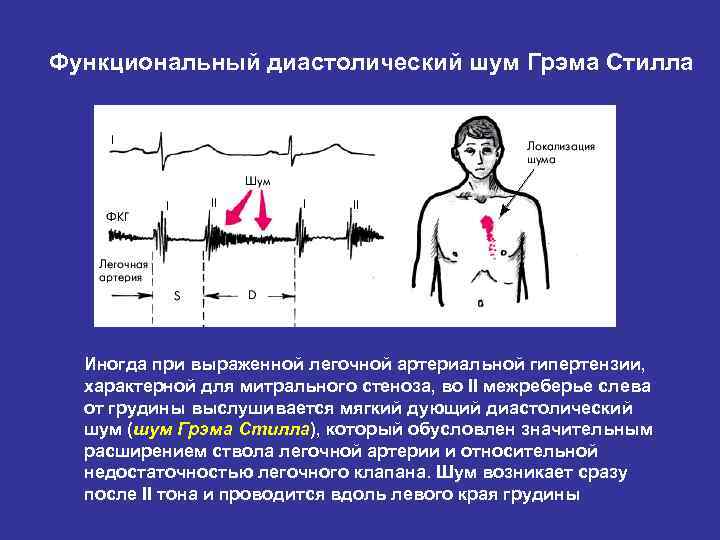 Функциональный диастолический шум Грэма Стилла Иногда при выраженной легочной артериальной гипертензии, характерной для митрального