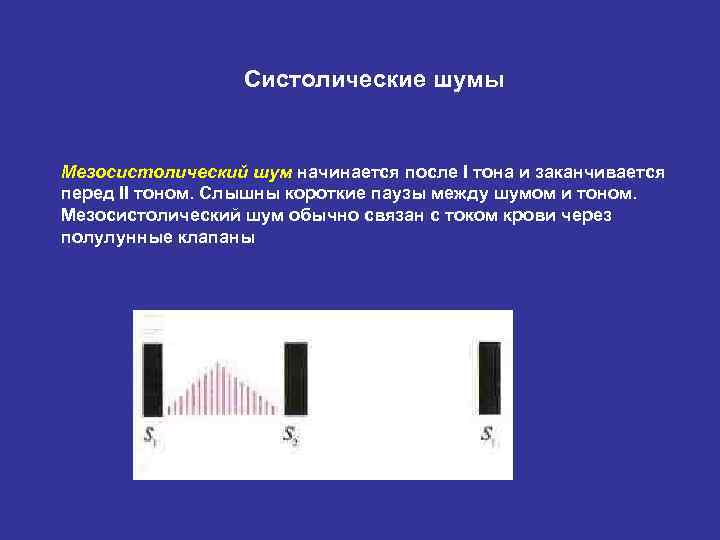 Систолические шумы Мезосистолический шум начинается после I тона и заканчивается перед II тоном. Слышны