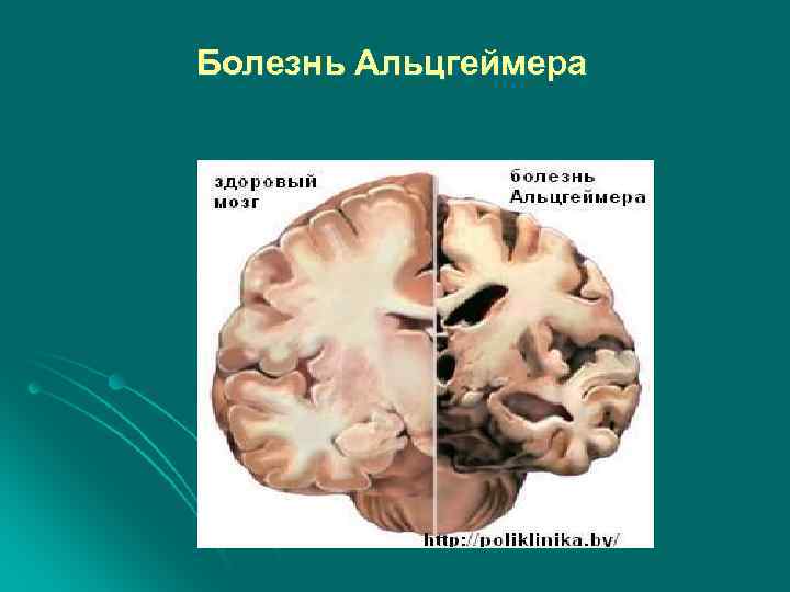 Болезнь Альцгеймера 
