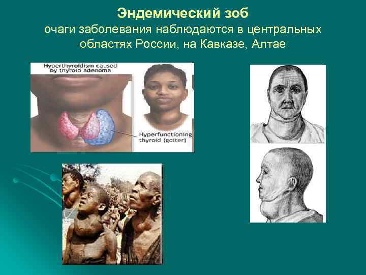 Эндемический зоб очаги заболевания наблюдаются в центральных областях России, на Кавказе, Алтае 