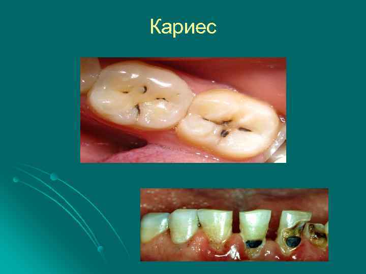 Кариес 