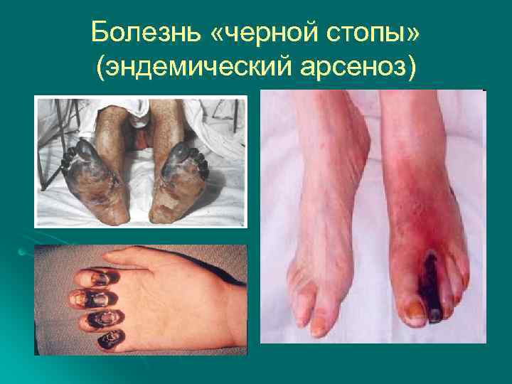 Болезнь «черной стопы» (эндемический арсеноз) 