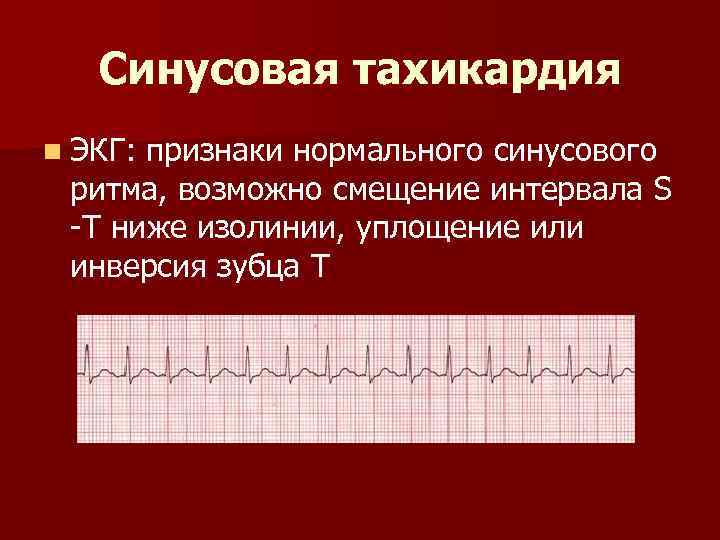 Синусовая тахикардия n ЭКГ: признаки нормального синусового ритма, возможно смещение интервала S -T ниже