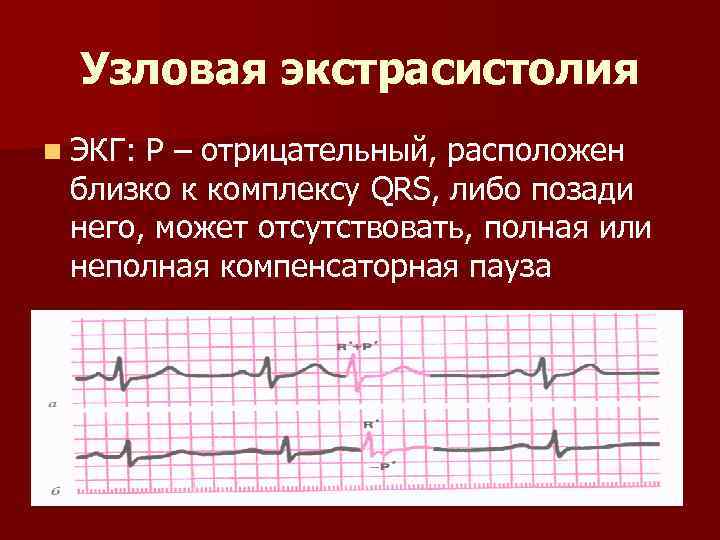 Узловая экстрасистолия n ЭКГ: Р – отрицательный, расположен близко к комплексу QRS, либо позади