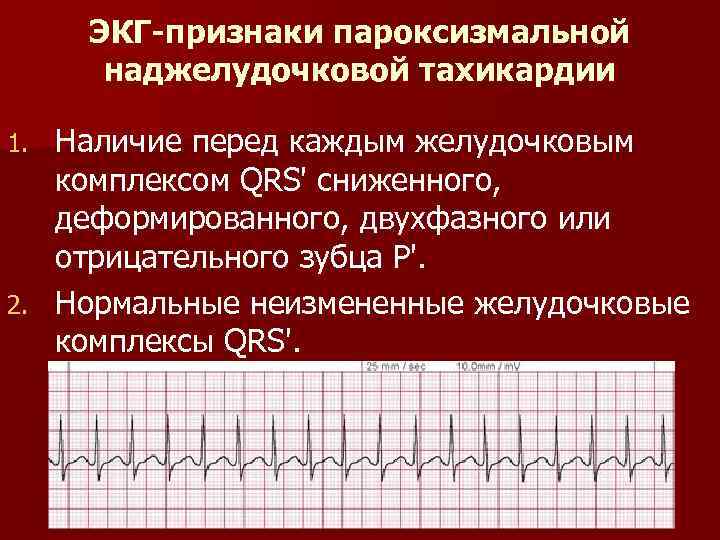 ЭКГ-признаки пароксизмальной наджелудочковой тахикардии Наличие перед каждым желудочковым комплексом QRS' сниженного, деформированного, двухфазного или