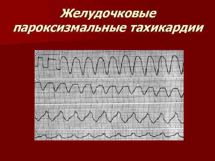 Желудочковые пароксизмальные тахикардии 