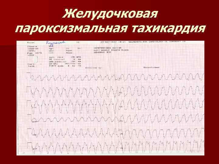 Пароксизмальная желудочковая тахикардия карта вызова смп