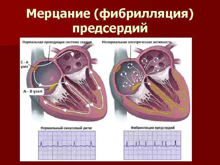 Мерцание (фибрилляция) предсердий 